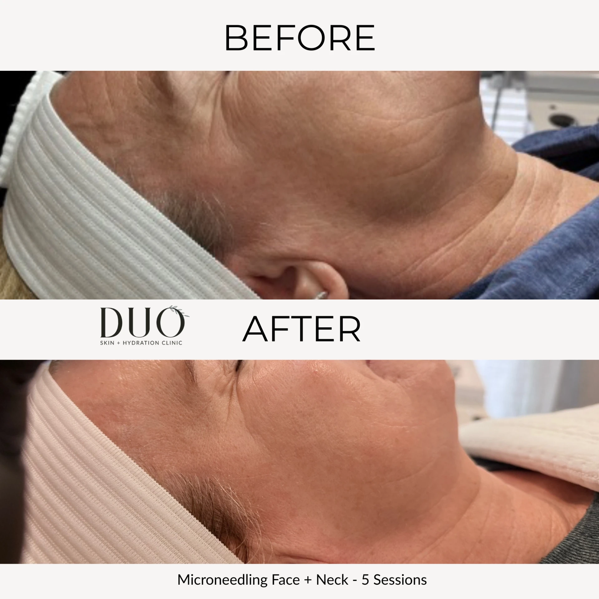 Before and after photos of microneedling on the face and neck after five sessions, side view