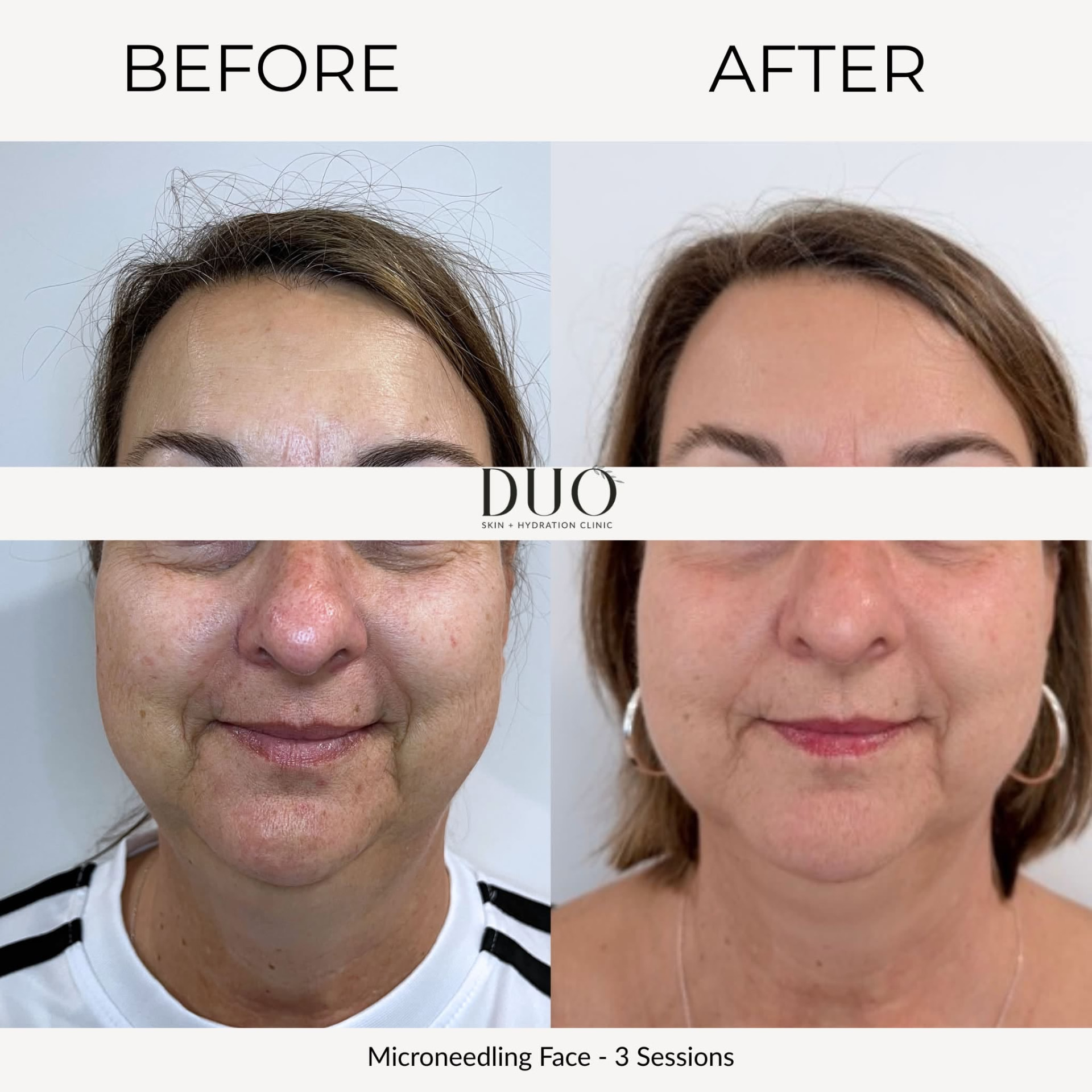 Before and after photos of microneedling on the face after three sessions