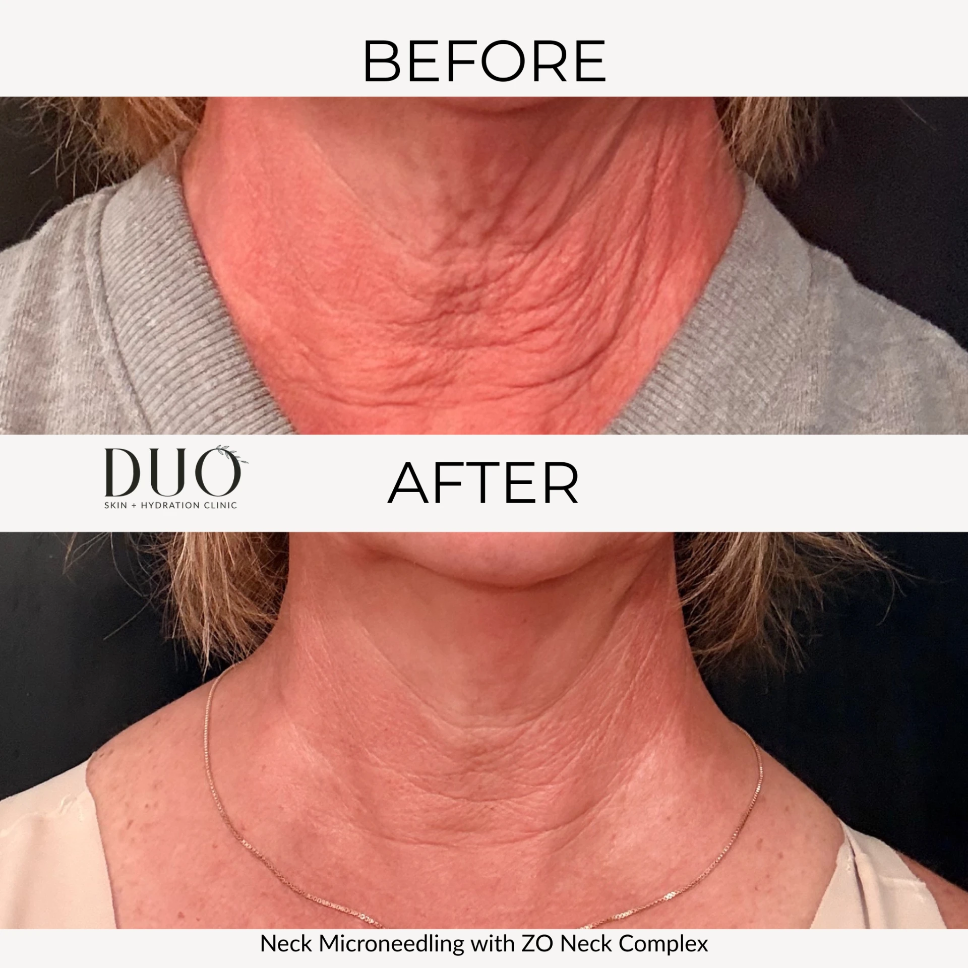 Before and after photos of neck microneedling with ZO Neck Complex