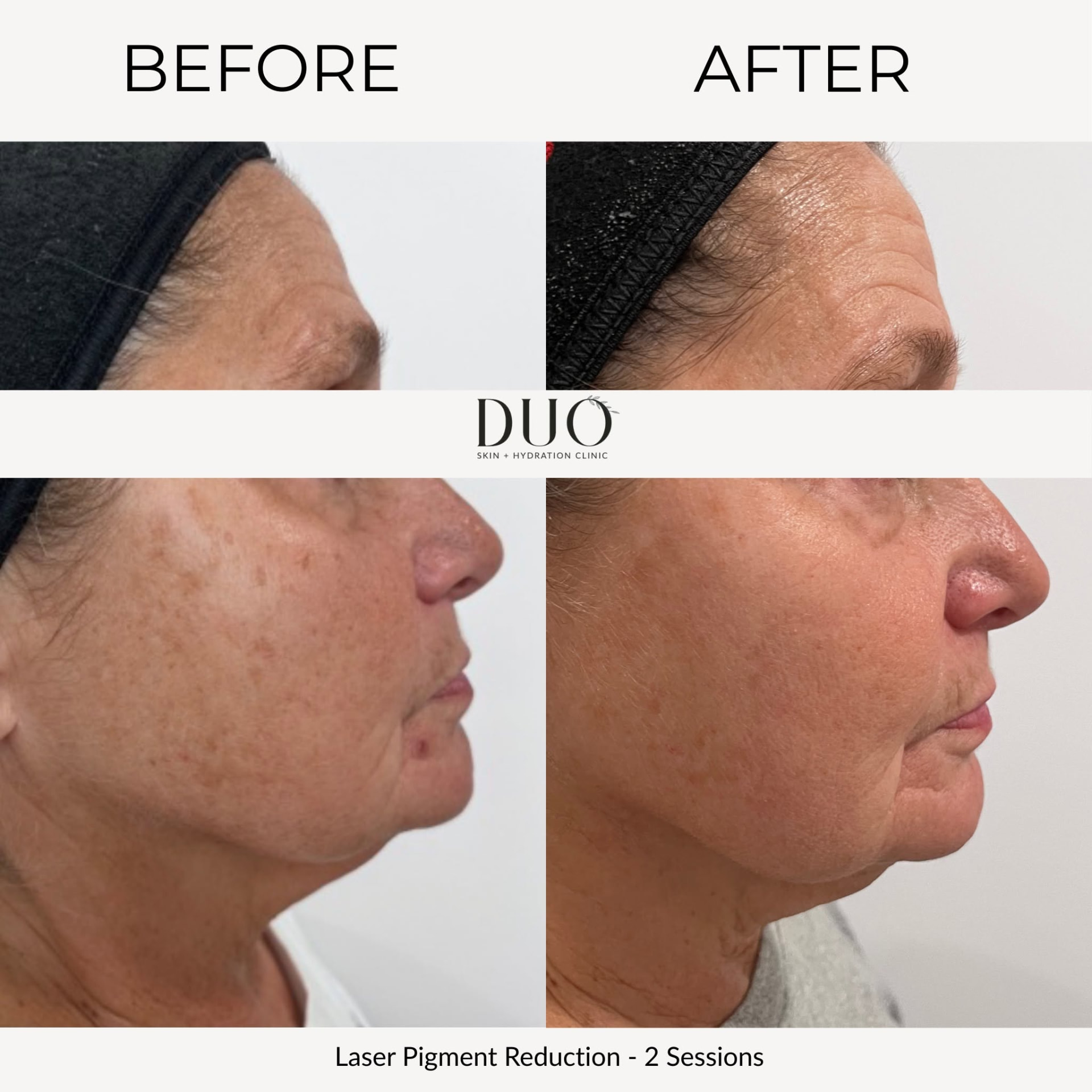 Before and after photos of laser pigment reduction on the face after two sessions, right profile