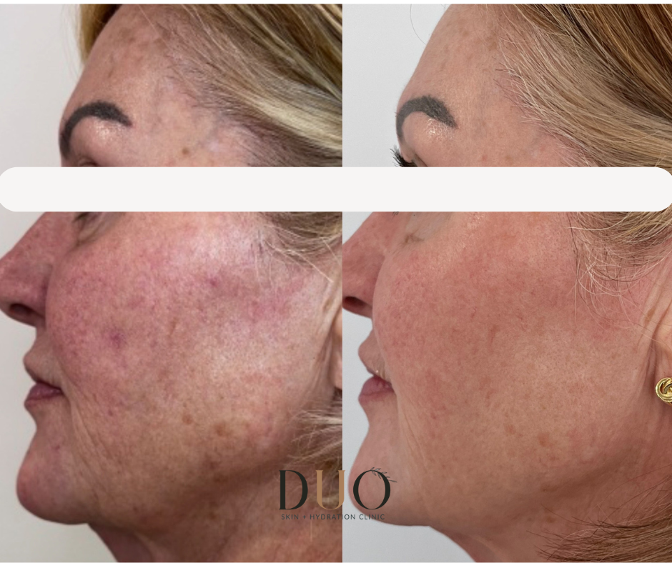 Side-by-side before and after photos of the face, left profile