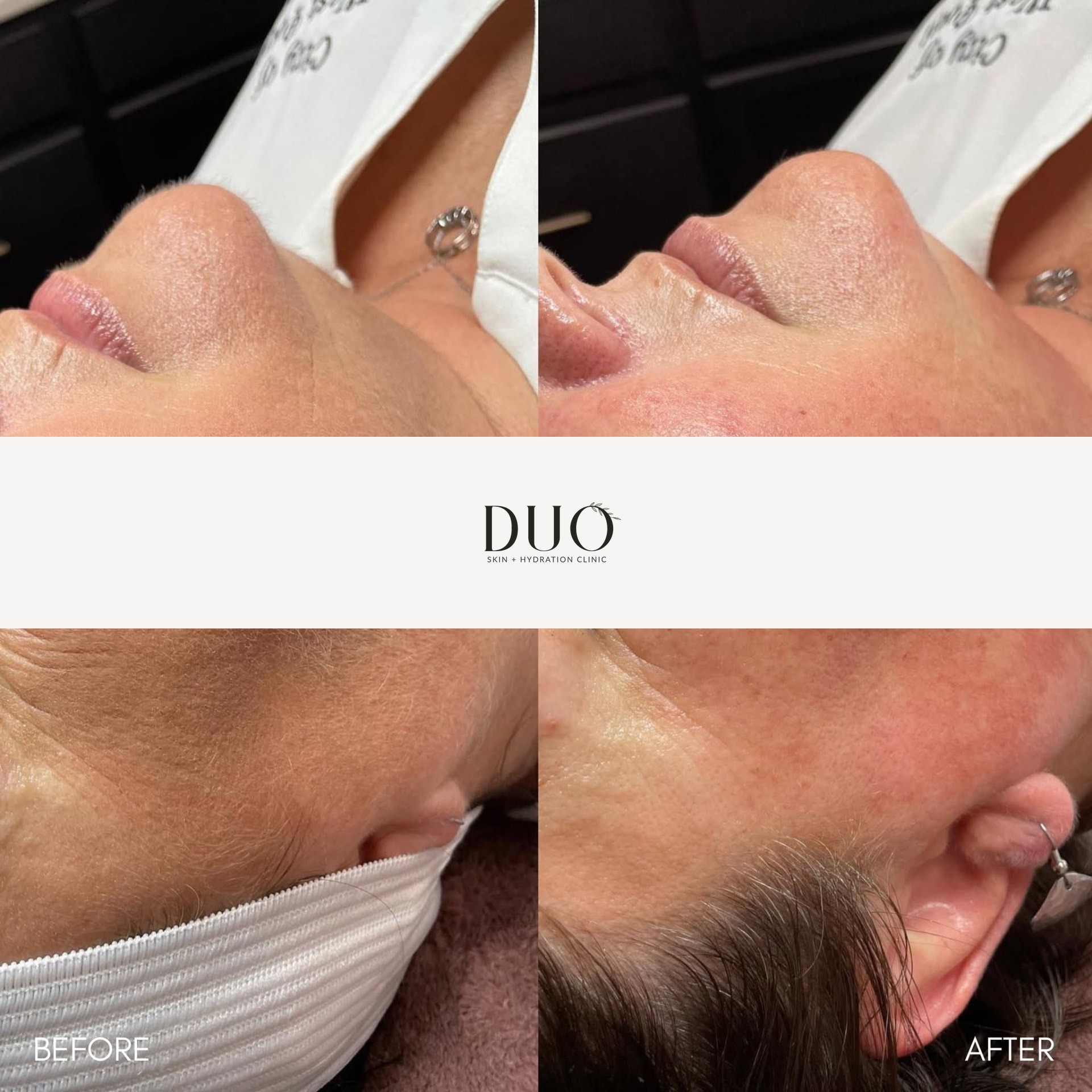 Before and after photos of the left cheek and jawline after a series of customized facials and dermaplaning