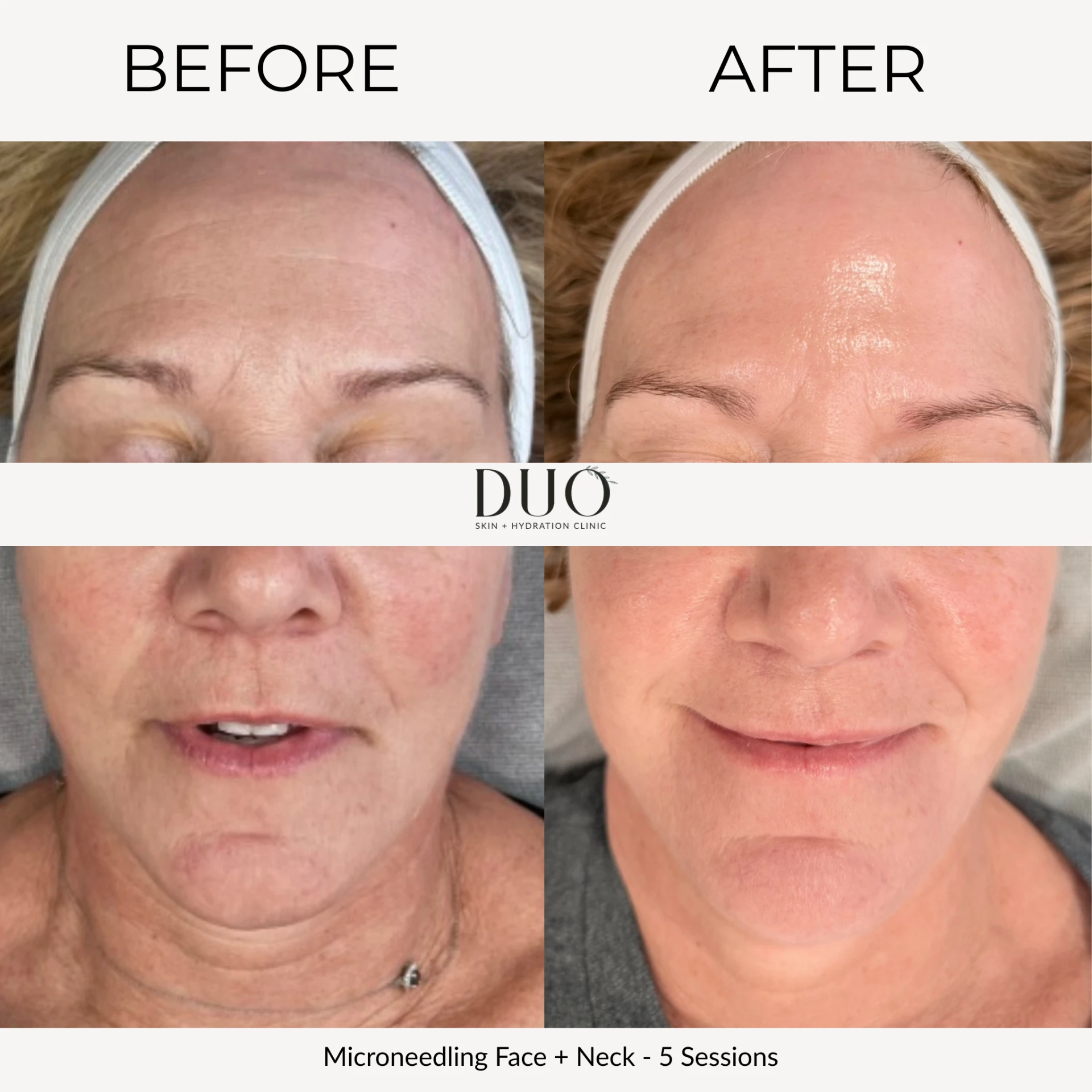 Before and after photos of microneedling on the face and neck after five sessions, front view