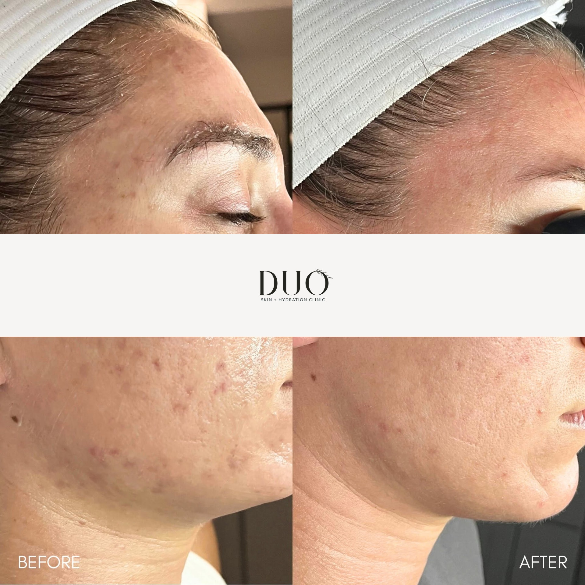 Before and after photos of the right cheek and jawline after a series of customized facials and dermaplaning