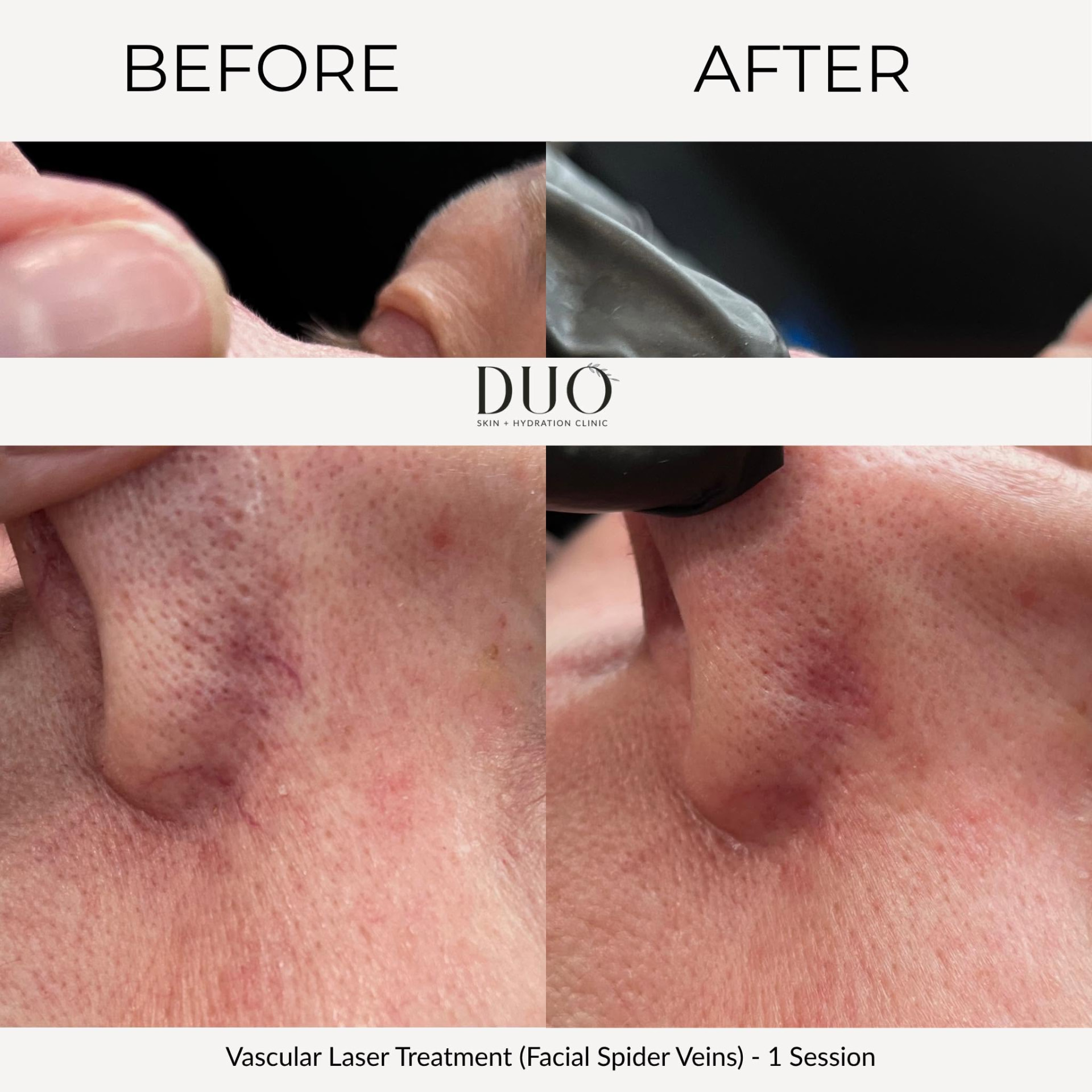 Before and after photos of the side of the nose and cheek after one vascular laser session for facial spider veins