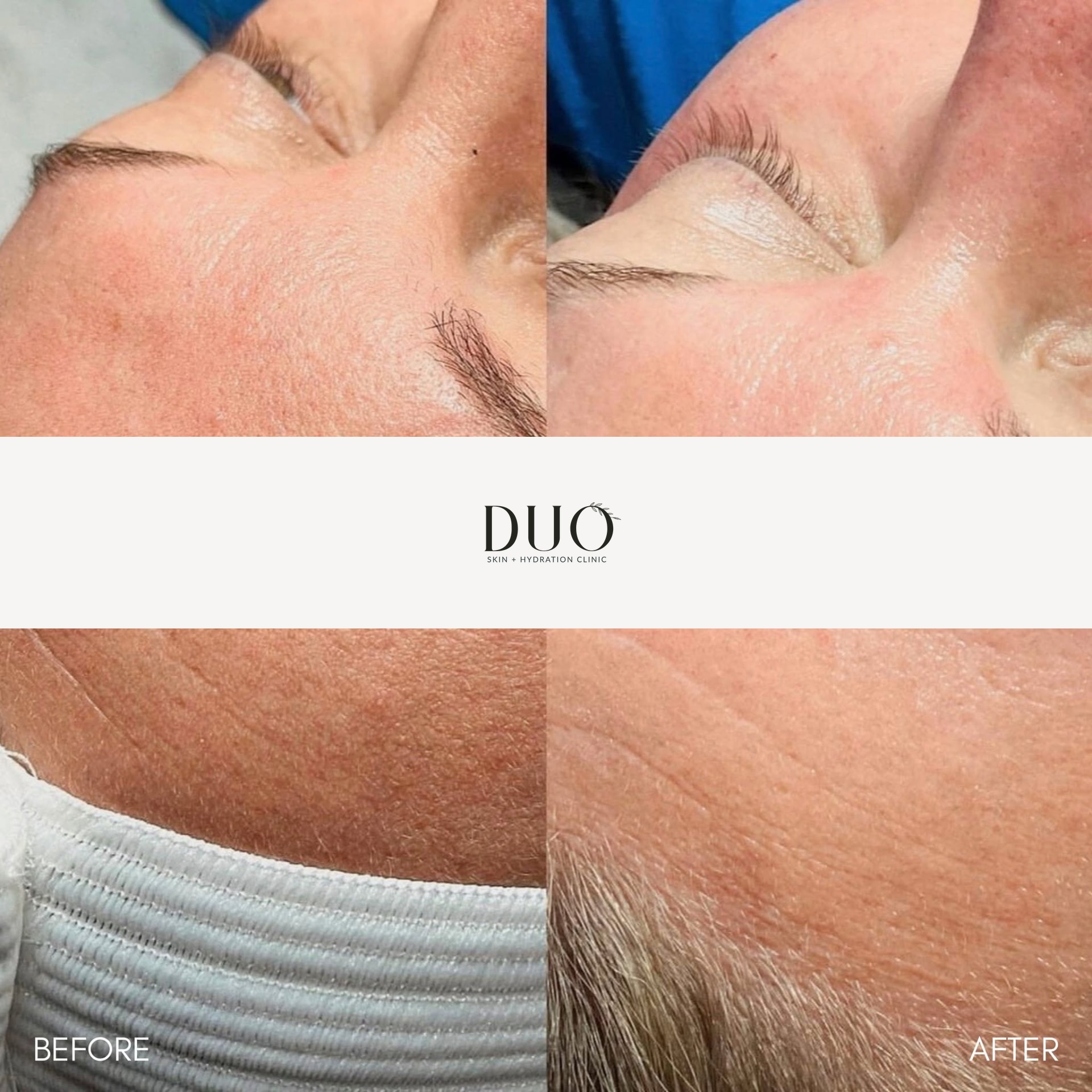Before and after photos of the forehead and temple after a series of customized facials and dermaplaning