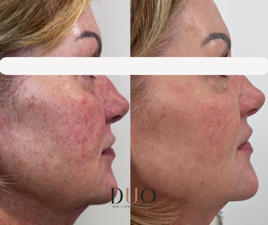 Side-by-side before and after photos of the face, right profile