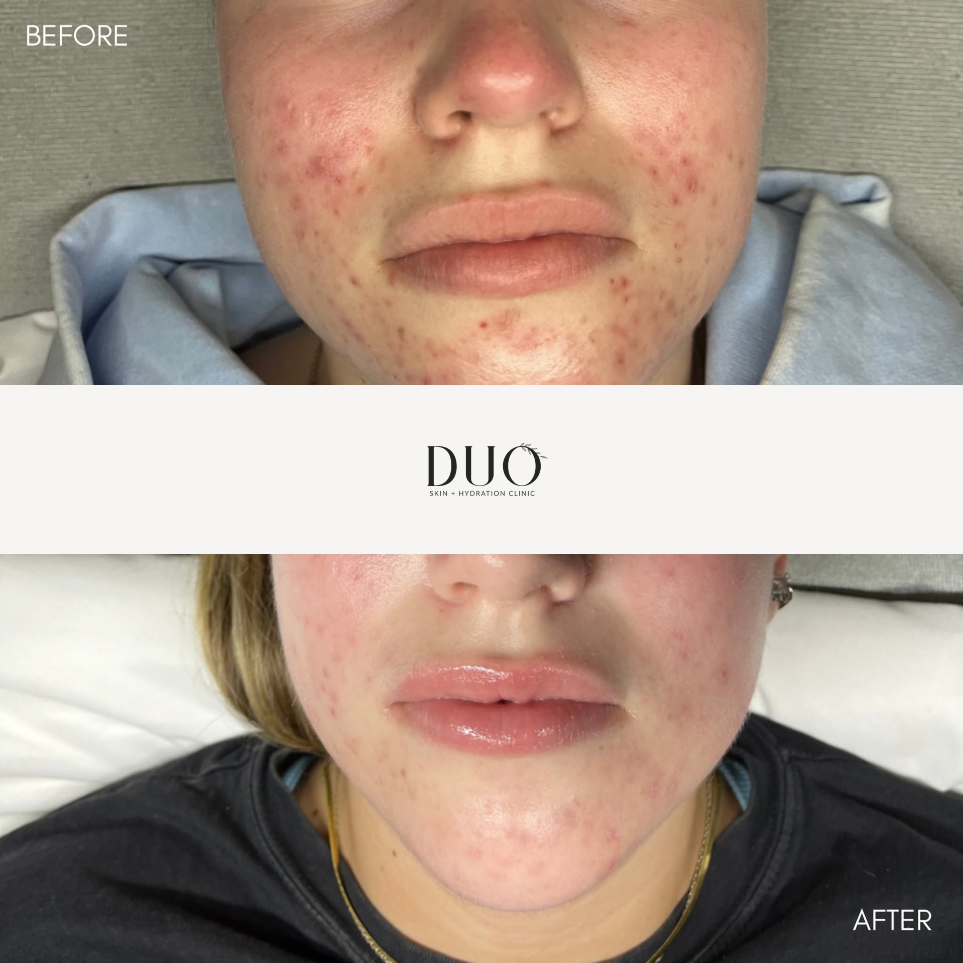 Before and after photos of the front of the face after a series of customized facials and dermaplaning