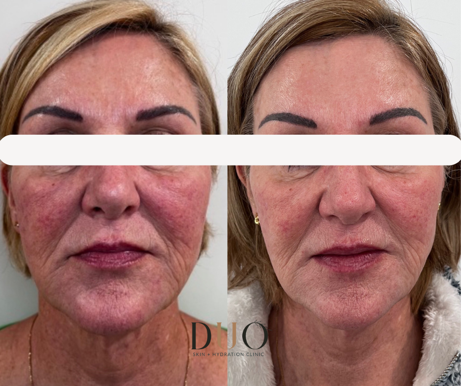 Side-by-side before and after photos of the face, front view