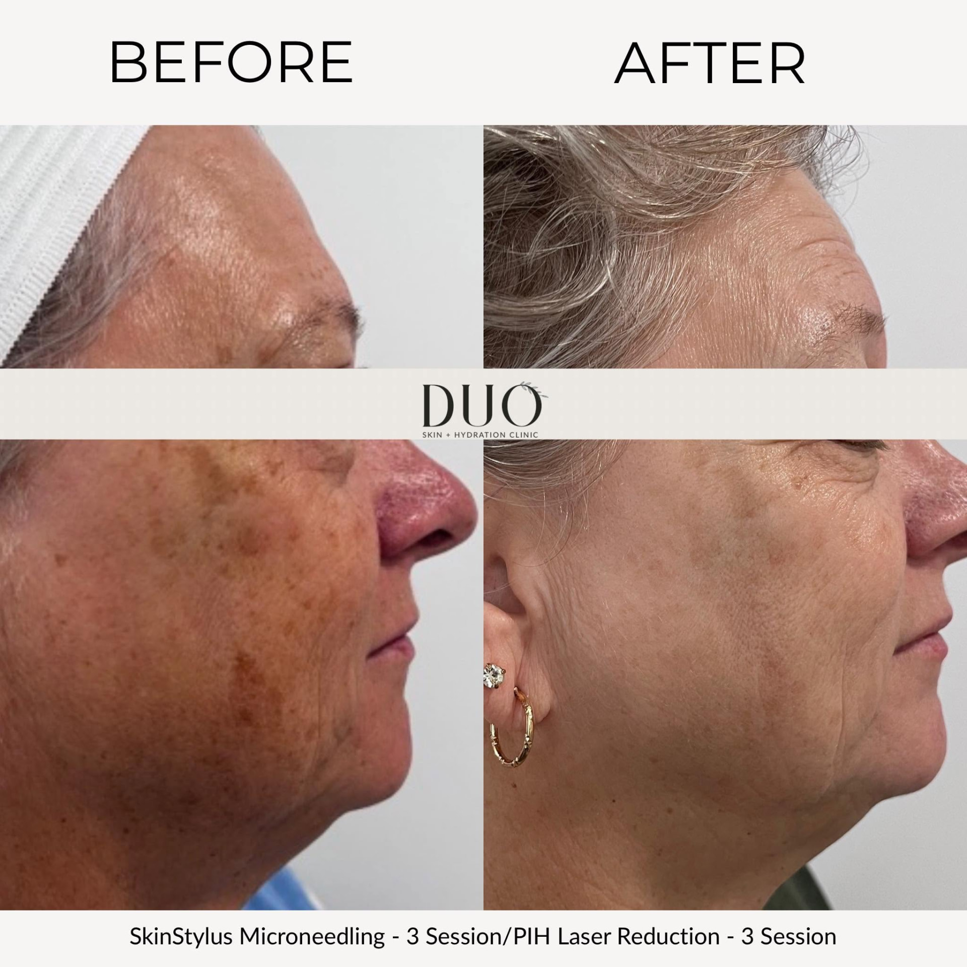 Before and after photos of the face after three sessions of microneedling and three sessions of PIH laser reduction, right profile